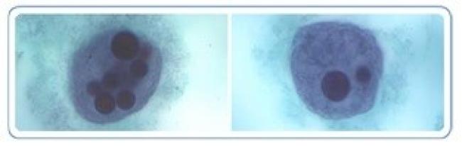 Gastrointestinal parasitic infections in immigrant and refugee children