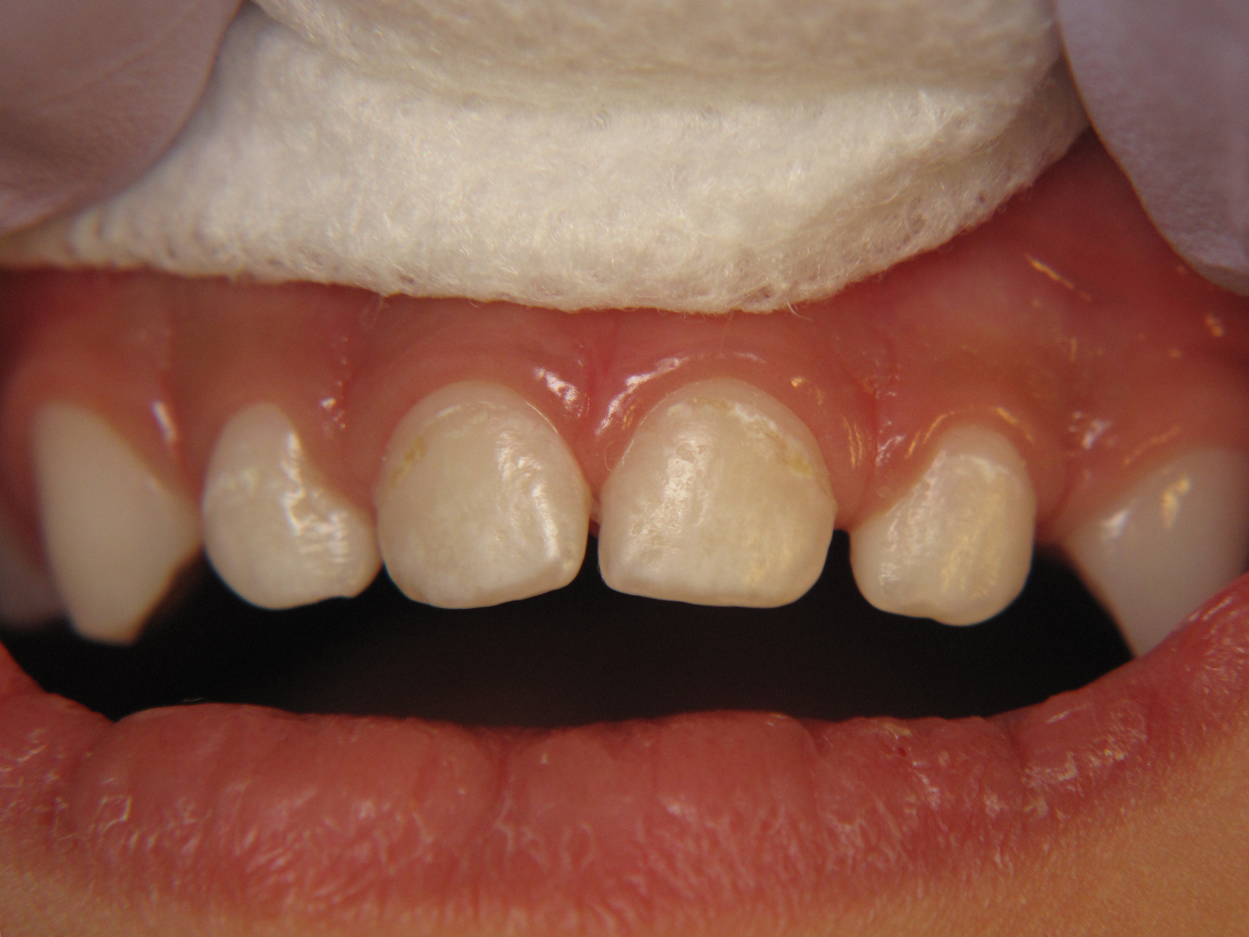 Figure 3. Mild dental disease